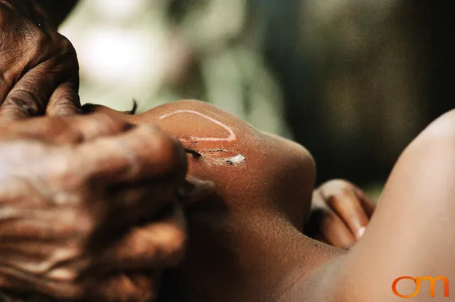 Photo of a girl getting a Solomon Island traditional facial scar. Taken of Caroline in the Malaita Province by Amanda Fornal in December 2006.