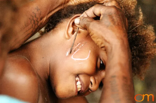 Photo of a girl getting a Solomon Island traditional facial scar. Taken of Caroline in the Malaita Province by Amanda Fornal in December 2006.