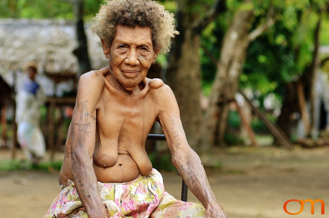 Photo of Vanuatu woman with a traditional tattoos on her arms. Taken on the Vanuatu Island of Mota Lava by Amanda Fornal in December 2006.